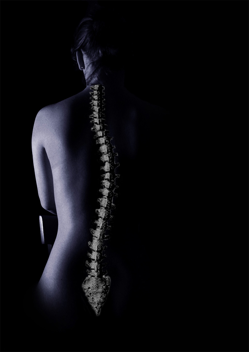 Escoliosis