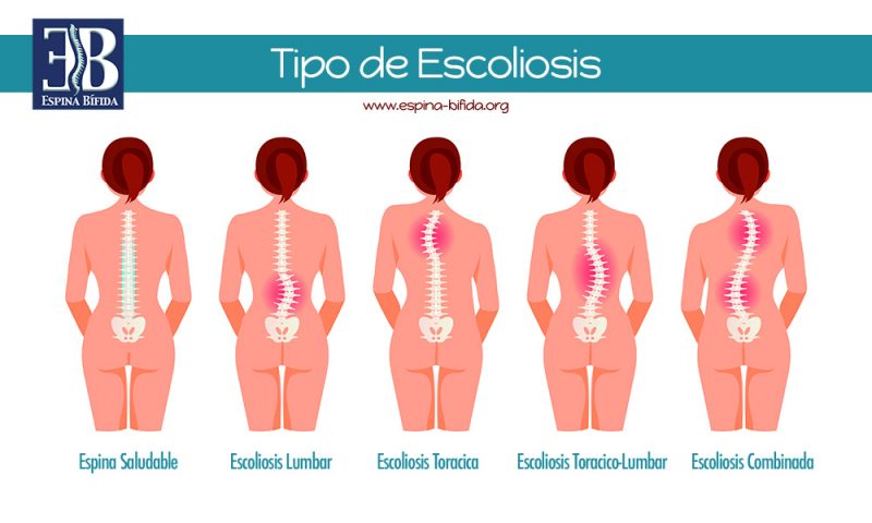 Escoliosis